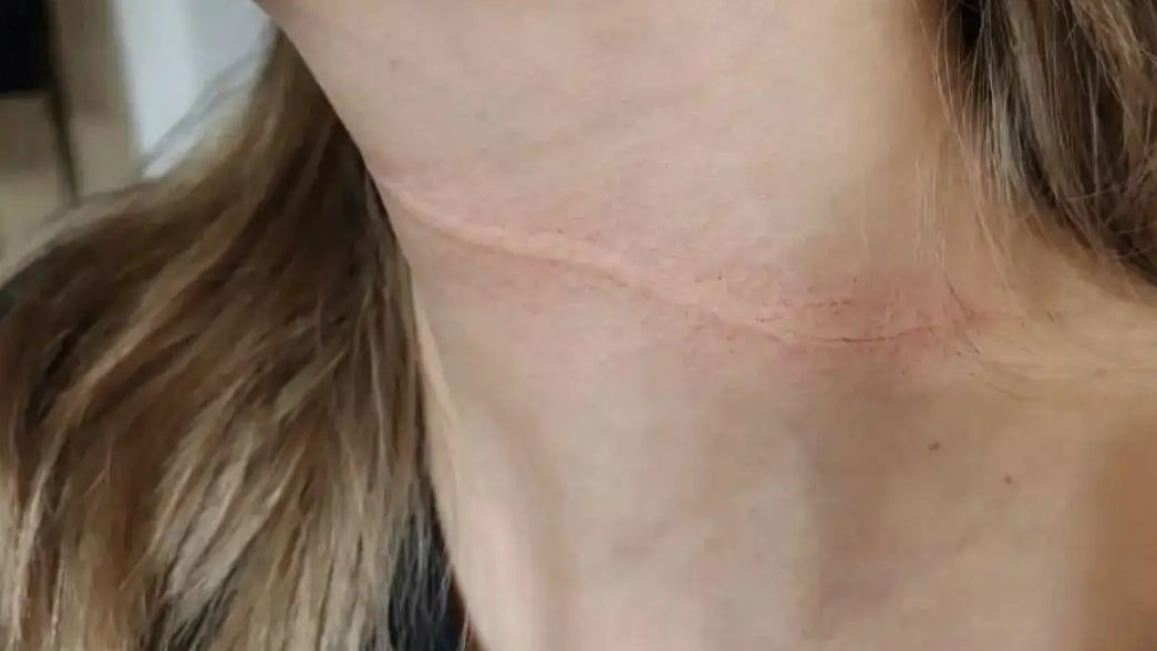 女子夜骑经过大桥 突被细线勒颈
