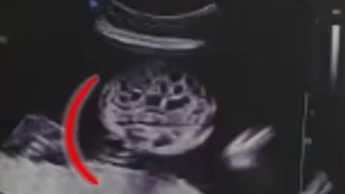  产检发现胎儿在妈妈腹中拉肚子