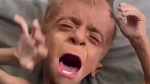 加沙儿童严重脱水 哭时没有一滴眼泪