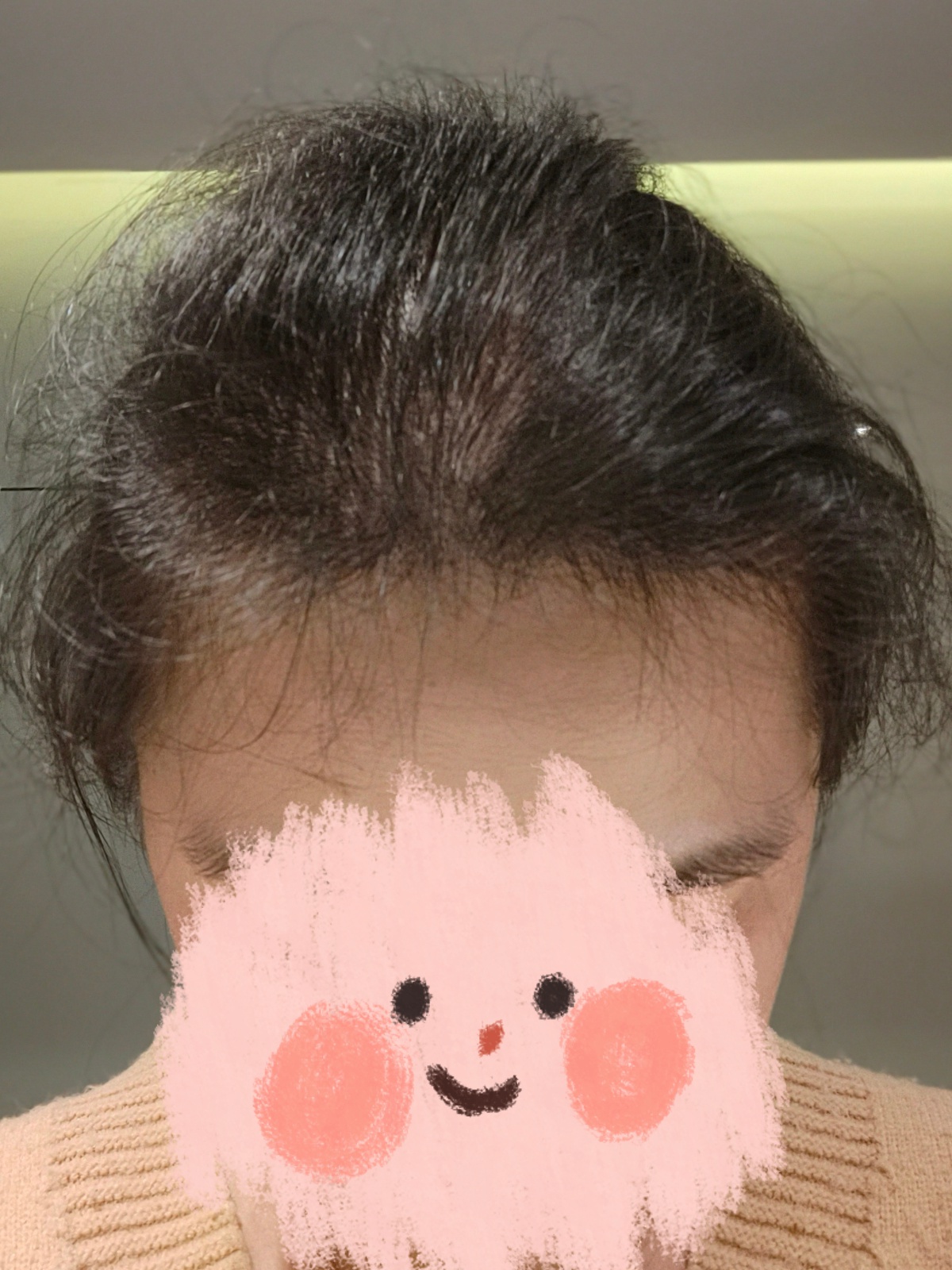  女子因脱发30岁被误认为奶奶