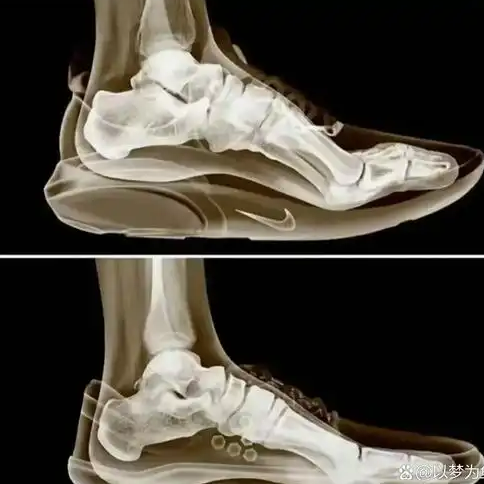 孩子跟风买的碳板鞋或毁脚