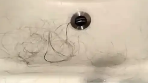 女子睡觉时被虫咬断一大把头发