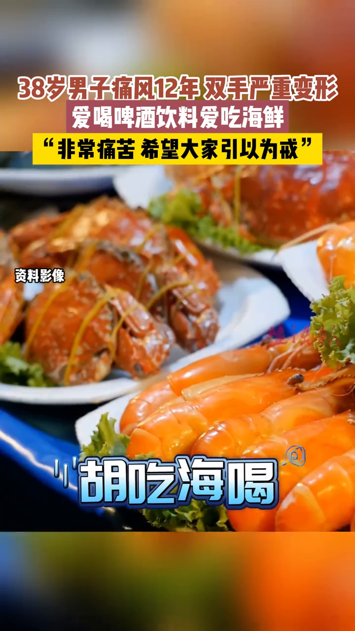  男子爱喝啤酒吃海鲜 患痛风双手变形