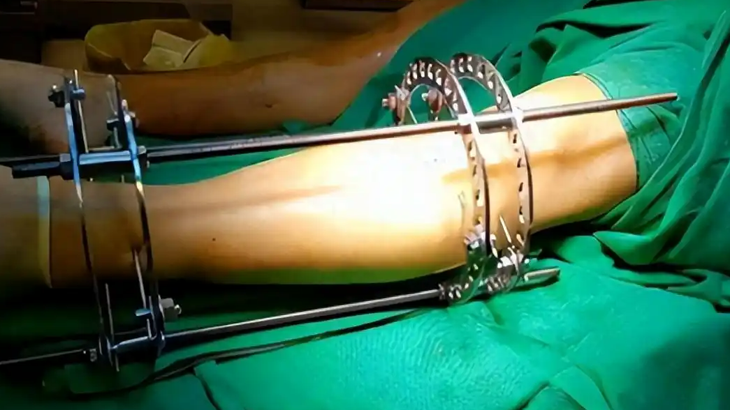 “断骨增高术”隐蔽宣传死灰复燃