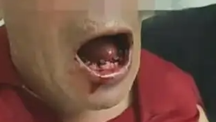 老人2天被拔除21颗牙？区卫健委回应