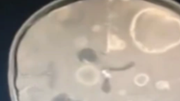 女童发烧17天脑子竟被啃出十几个洞