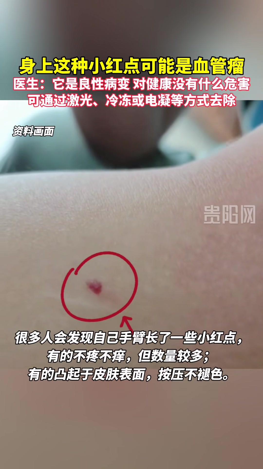身上的這種小紅點可能是血管瘤