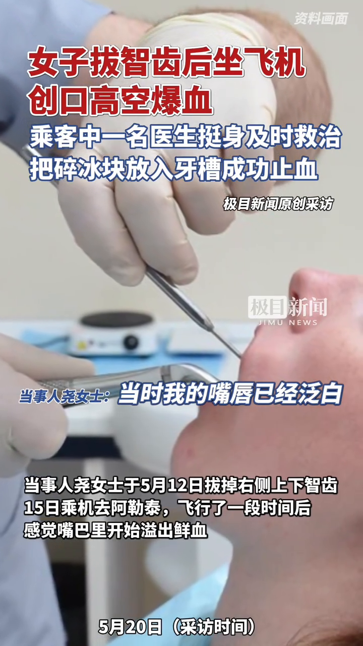  女子拔智齿后坐飞机创口高空爆血