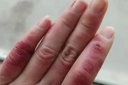   冻伤要到烧伤科就诊 缩略图