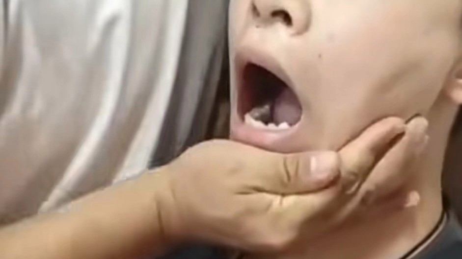高考生进考场前下巴脱臼