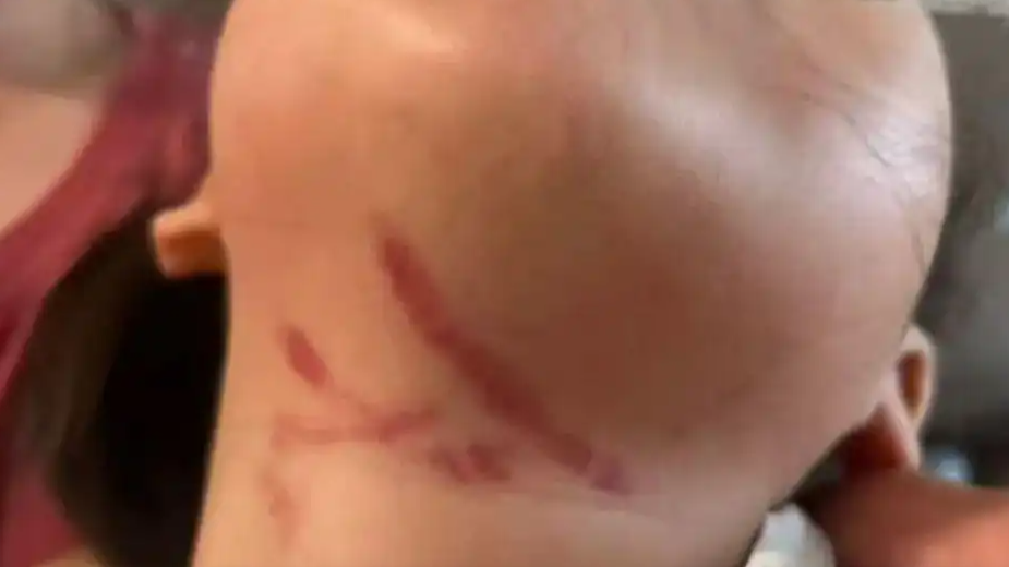  女童疑遭幼儿园男老师暴力喂食受伤