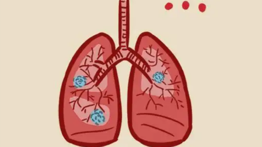 钟南山团队发现71%肺结节患者不吸烟