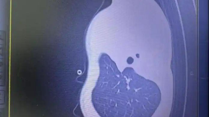 11岁男孩连续两年因流感急送ICU