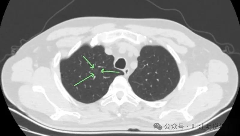 母亲做肺癌手术 儿子陪护也查出肺癌