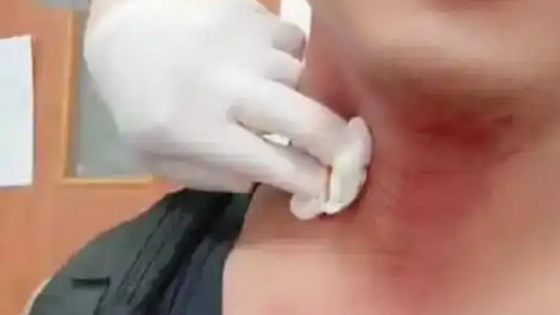  男子被蚊子叮咬脖子鲜血直流