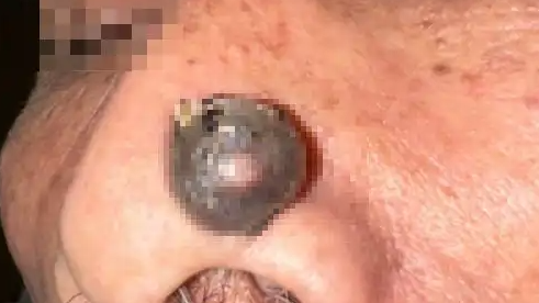  大爷鼻子上长了小疙瘩竟确诊是癌