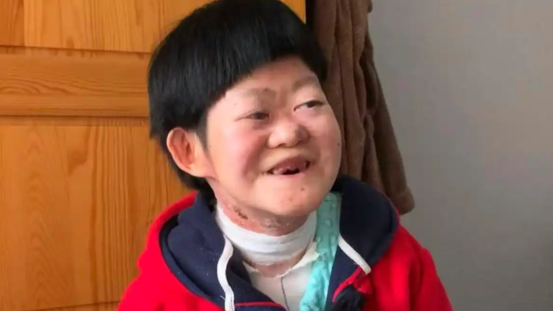 被断言活不过2岁的蝴蝶宝贝将满25岁