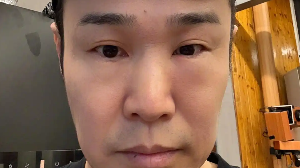 小沈阳一觉睡醒眼睛肿成蜜蜂小狗
