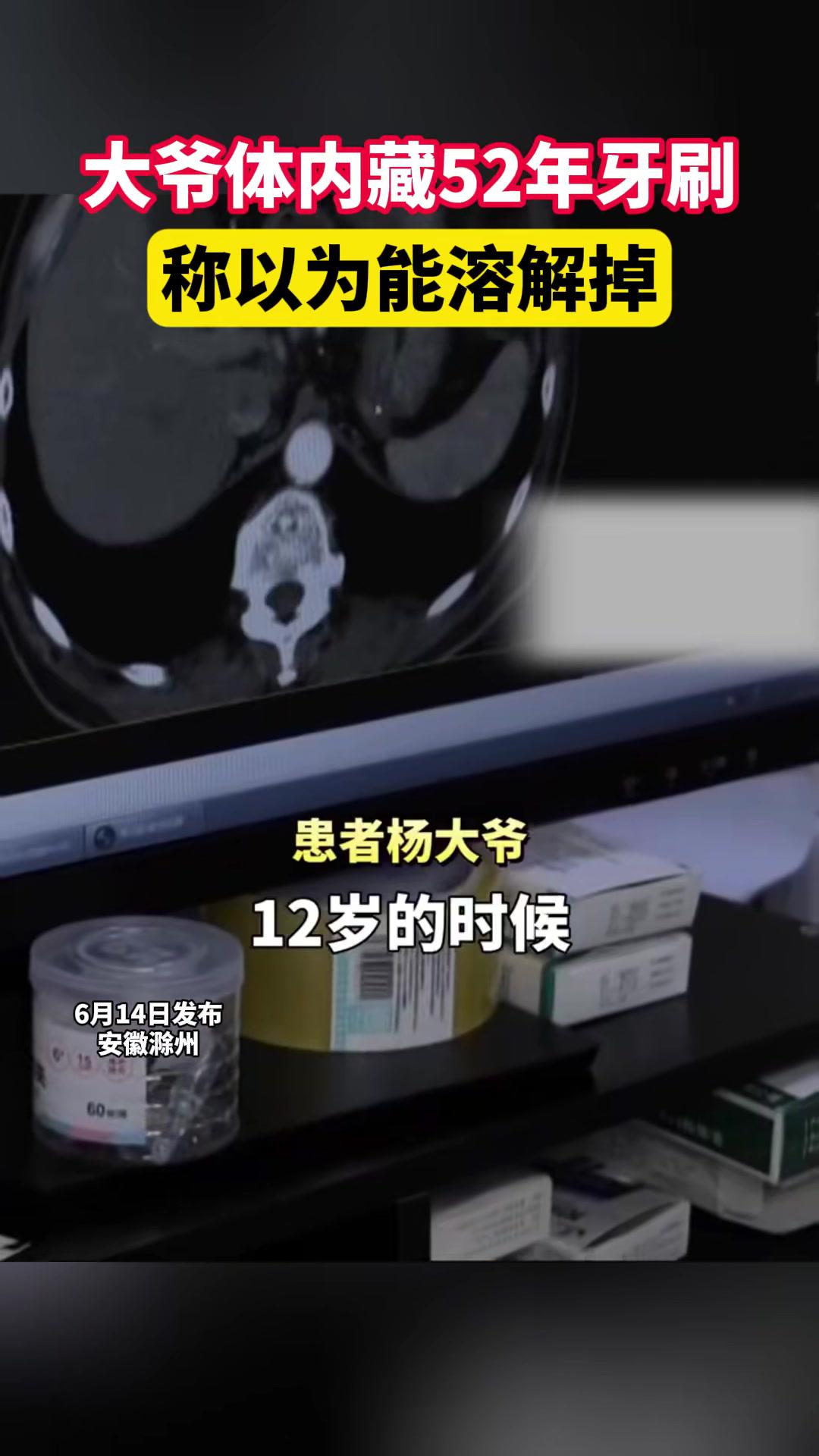  大爷体内藏52年牙刷称以为能溶解掉