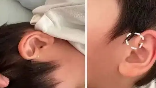 耳朵上的这个小洞千万别挤