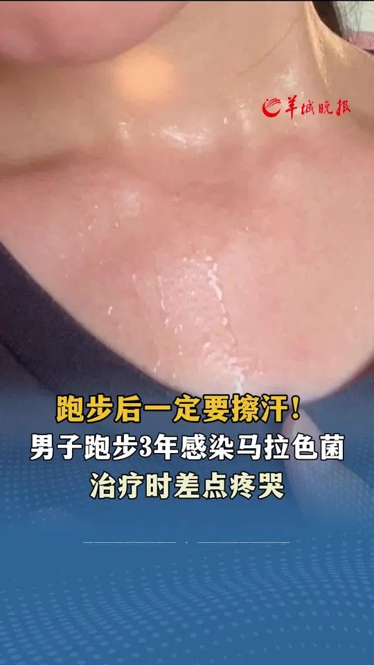 男子跑步后未擦汗感染马拉色菌