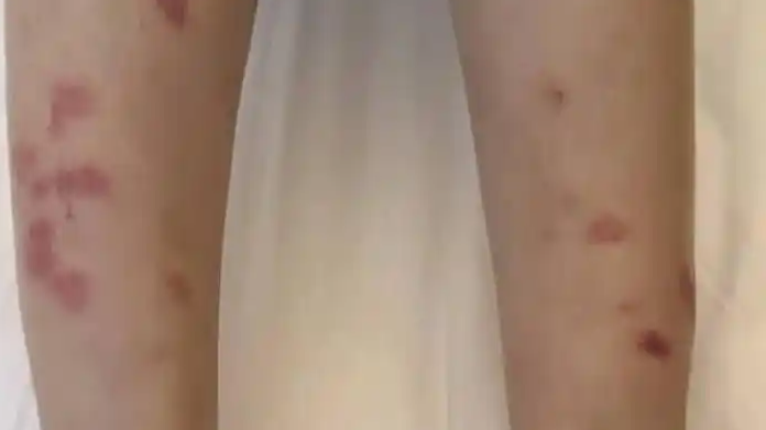 花2000住希尔顿 腿上出现大片红疹