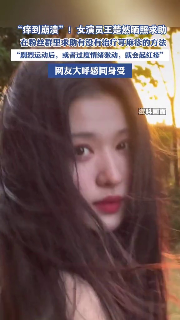  演员王楚然求助荨麻疹治疗方法