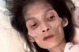   胃萎缩暴瘦至35斤女子去世 年仅27岁 缩略图