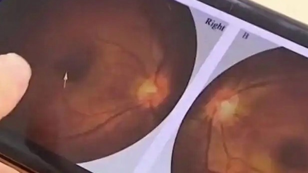  男婴洗澡久盯浴霸灯右眼永久弱视