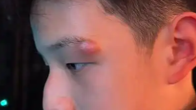 关凌向儿子道歉：我一失手他缝了四针